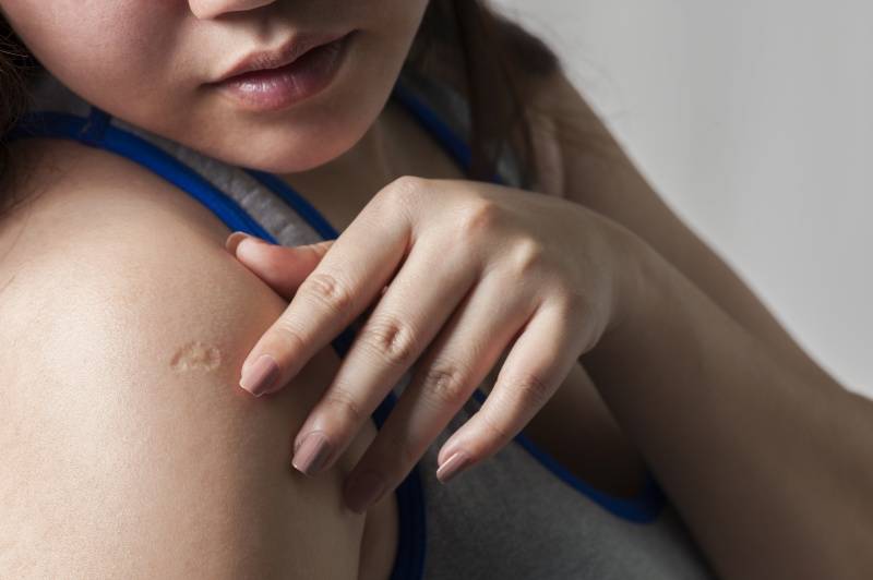 Que Significa La Cicatriz En Tu Brazo Derecho Y Por Que Todos La Tenemos Mentes Curiosas