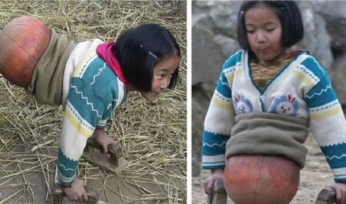 Así se ve "la niña pelota" después de 11 años - fue abandonada pero ahora ..