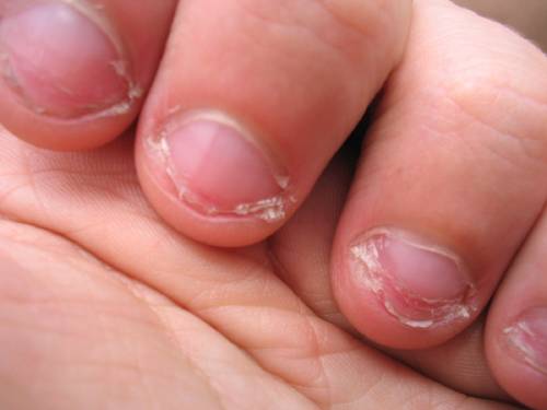 ¿Te muerdes las uñas? Deberías leer esto
