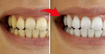 ¡Dos recetas sencillas y naturales que dejarán tus dientes como nuevos!