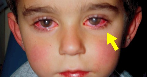 Este pequeño “juguete” hizo que un niño perdiera gran parte de su visión