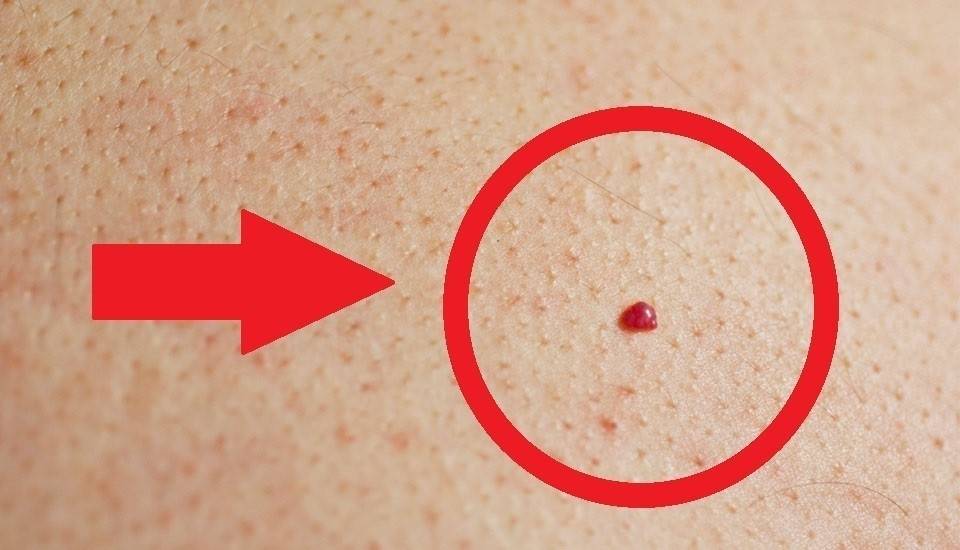 ¿Qué significan los puntos rojos que salen en la piel?