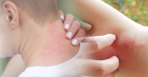 ¿Te picó algo y no sabes qué es? Cómo identificar las 8 picaduras más comunes y dolorosas ¿Te picó algo y no sabes qué es? Cómo identificar las 8 picaduras más comunes y dolorosas