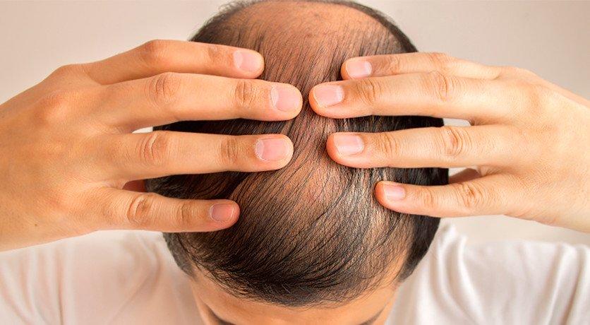 Pérdida de cabello, un nuevo posible síntoma del covid-19