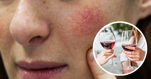 Te sonrojas cuando bebes alcohol Te sonrojas cuando bebes alcohol