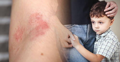 enrojercimiento brazo niño Un niño con el brazo enrojecido