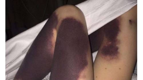 Al despertar, vio a su hija con hematomas en las piernas, cuando sepas el porq..