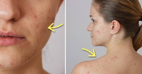 10 cosas comunes que están arruinando tu piel sin que lo sepas