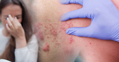 Culebrilla: la enfermedad que se activa con el estrés y podría causar ceguera Culebrilla: la enfermedad que se activa con el estrés y podría causar ceguera