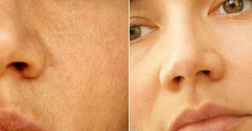 Cómo cerrar poros dilatados Poros dilatados: consejos y remedios para evitarlos