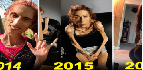 Así luce hoy la mujer que sufrió el peor caso de anorexia del mundo