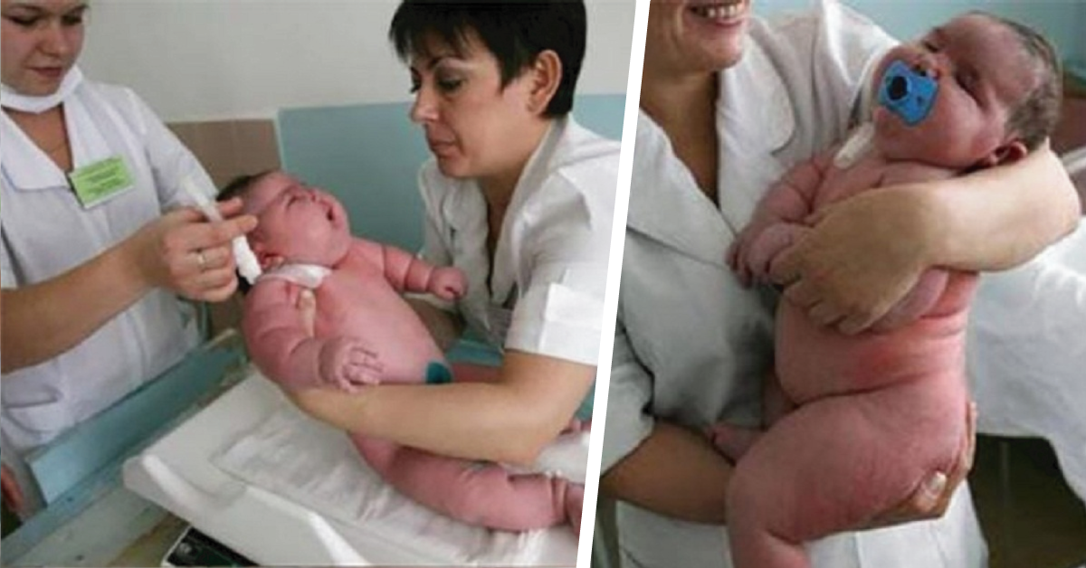 Este bebe al nacer pesó 18 kg 