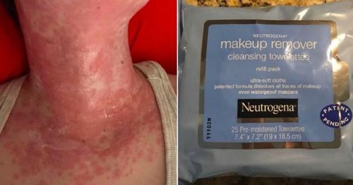 Toallitas desmaquillantes alergia piel Toallitas desmaquillantes alergia piel