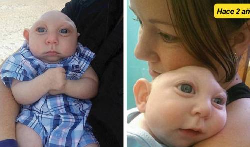 Este bebé nació sin una parte de su cráneo, a pesar de ello ha logrado crec..